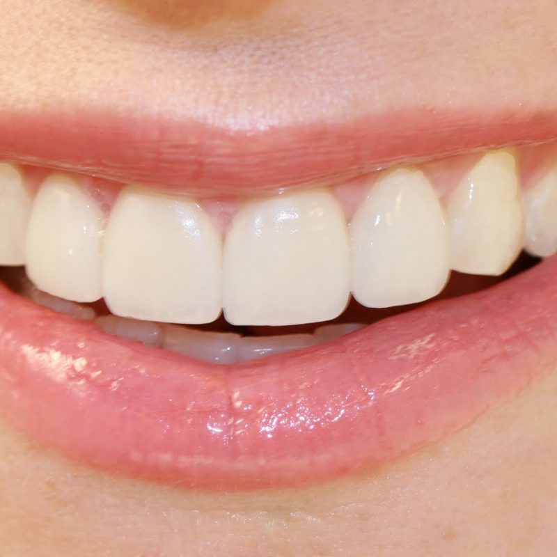Veneers & Improving Your Smile