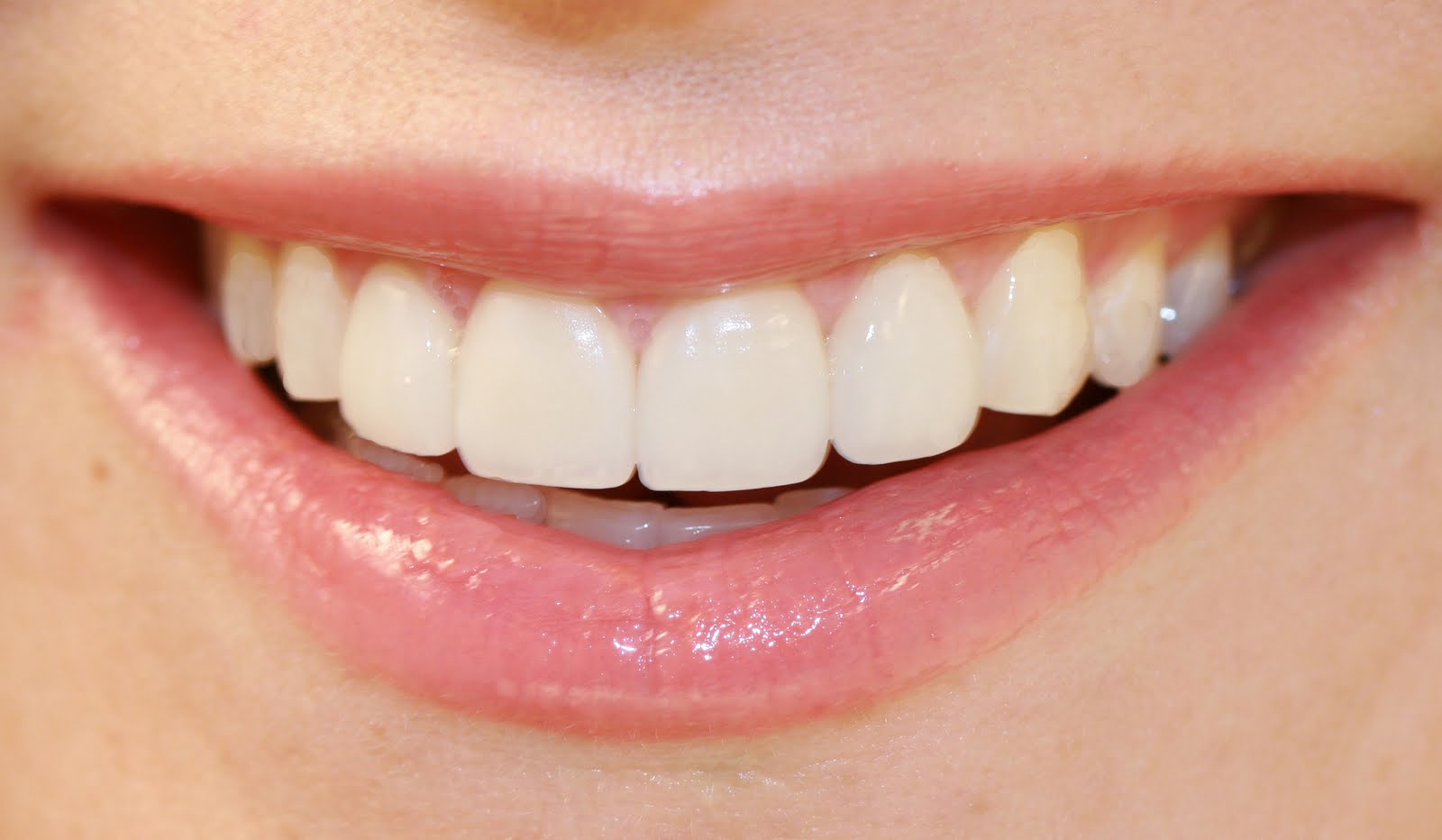 Veneers – Improving Your Smile